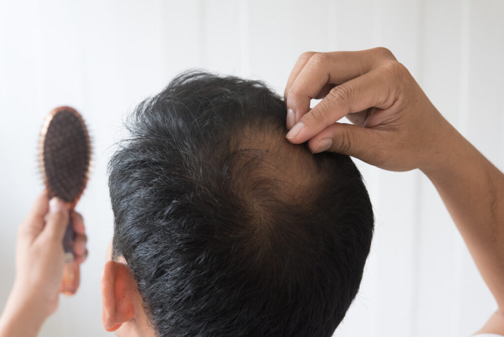A calvície é um problema comum que afeta homens e mulheres em diferentes fases da vida. Muitas vezes, a perda de cabelo pode ser um processo gradual e sutil, o que pode levar a atrasar o reconhecimento dos primeiros sinais.