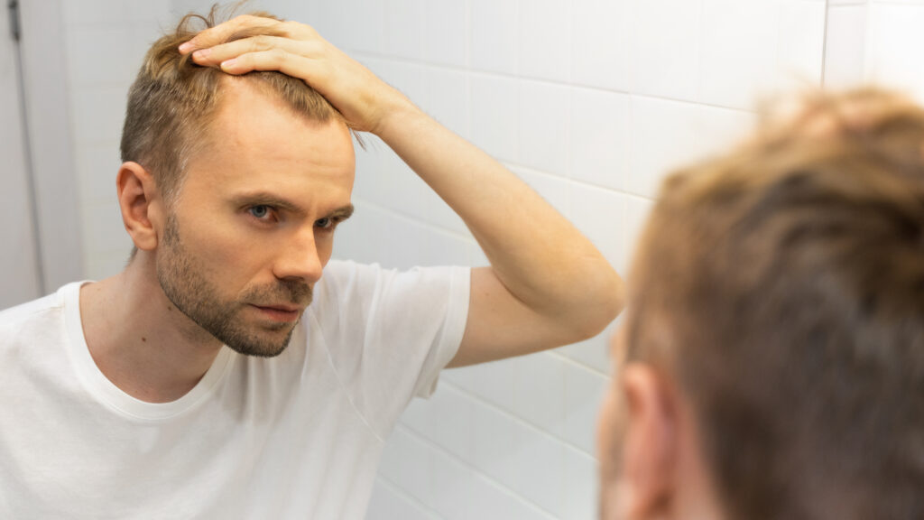 Além da queda de cabelo relacionada à genética, conhecida como alopécia androgenética, existem outros fatores que podem contribuir para esse problema. Portanto, é recomendável buscar a orientação de um profissional médico para uma avaliação adequada.
Quer saber mais a respeito das possíveis origens e das opções de tratamento para a queda de cabelo? Então fique nesta página e leia esse conteúdo completo.