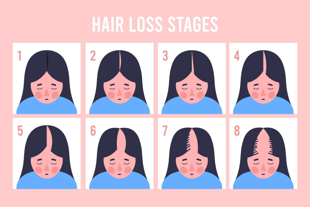 Hair Loss Stages: 1, 2, 3, 4, 5, 6, 7, 8.