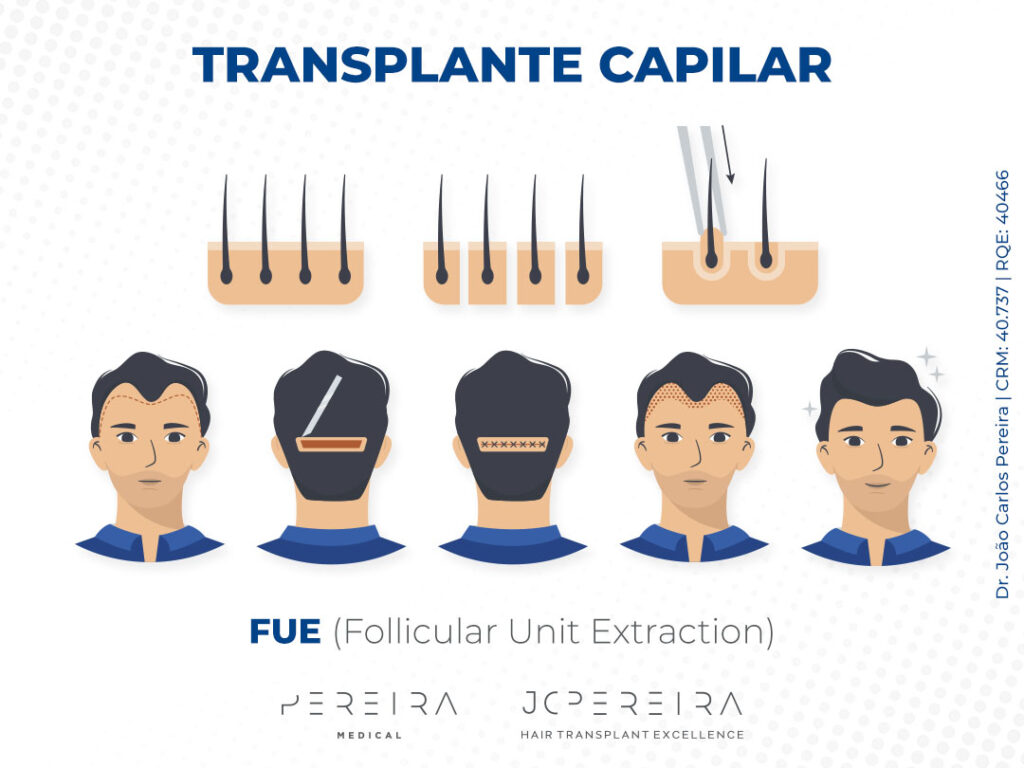Transplante capilar, FUE (Follicular Unit Extraction), Pereira Medical, JC Pereira Hair Transplant Excellence.