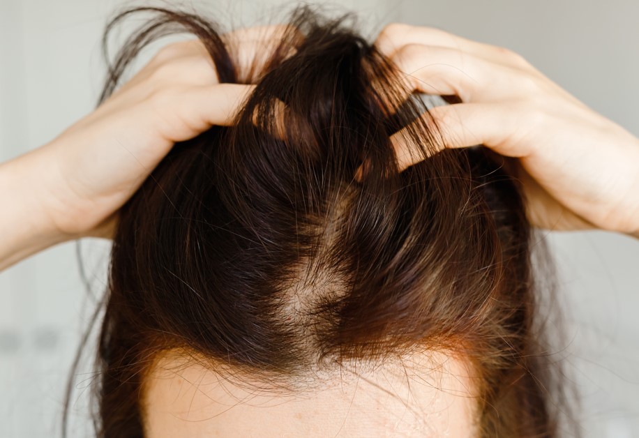 Diversos tipos de alopécia feminina podem desencadear a perda de cabelo, levando muitas mulheres a questionar se é possível recuperar os fios perdidos. Essa dúvida é compreensível, uma vez que o cabelo desempenha um papel significativo na aparência, autoestima e personalidade da maioria das mulheres. A boa notícia é que, uma vez diagnosticada a condição, existem tratamentos eficazes para estimular o crescimento capilar, incluindo o transplante capilar, um procedimento cirúrgico altamente eficiente para tratar a calvície e outros problemas relacionados ao afinamento progressivo dos fios.