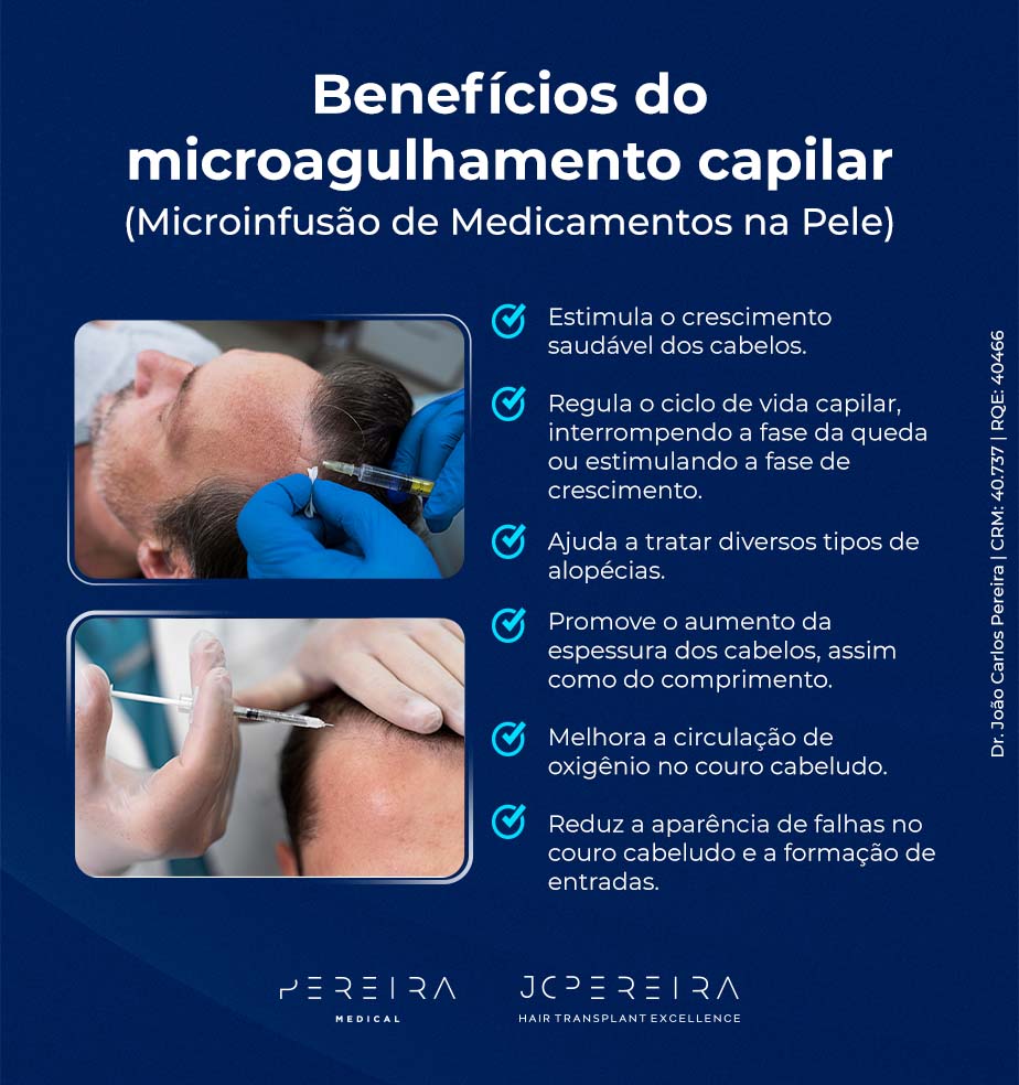 Benefícios do microagulhamento capilar (Microinfusão de Medicamentos na Pele)
Estimula o crescimento saudável dos cabelos.
Regula o ciclo de vida capilar, interrompendo a fase da queda ou estimulando a fase de crescimento.
Ajuda a tratar diversos tipos de alopécias.
Promove o aumento da espessura dos cabelos, assim como do comprimento.
Melhora a circulação de oxigênio no couro cabeludo.
Reduz a aparência de falhas no couro cabeludo e a formação de entradas.