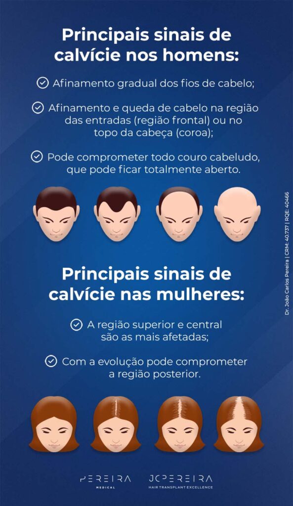 Principais sinais de calvície nos homens:
Afinamento gradual dos fios de cabelo;
Afinamento e queda de cabelo na região das entradas (região frontal) ou no topo da cabeço (coroa);
Pode comprometer todo couro cabeludo, que pode ficar totalmente aberto.

Principais sinais de calvície nas mulheres:
A região superior e central são as mais afetadas;
Com a evolução pode comprometer a região posterior.
