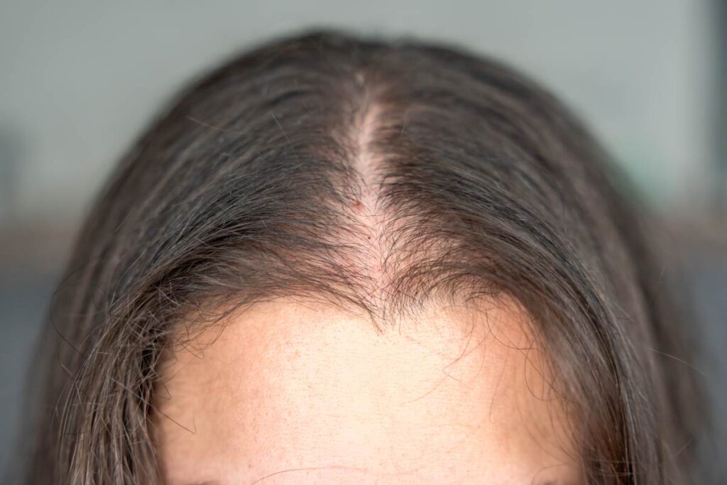 Calvície feminina frontal: causas, sintomas e como tratar a queda de cabelo na linha da testa A imagem mostra um caso de calvície feminina frontal,