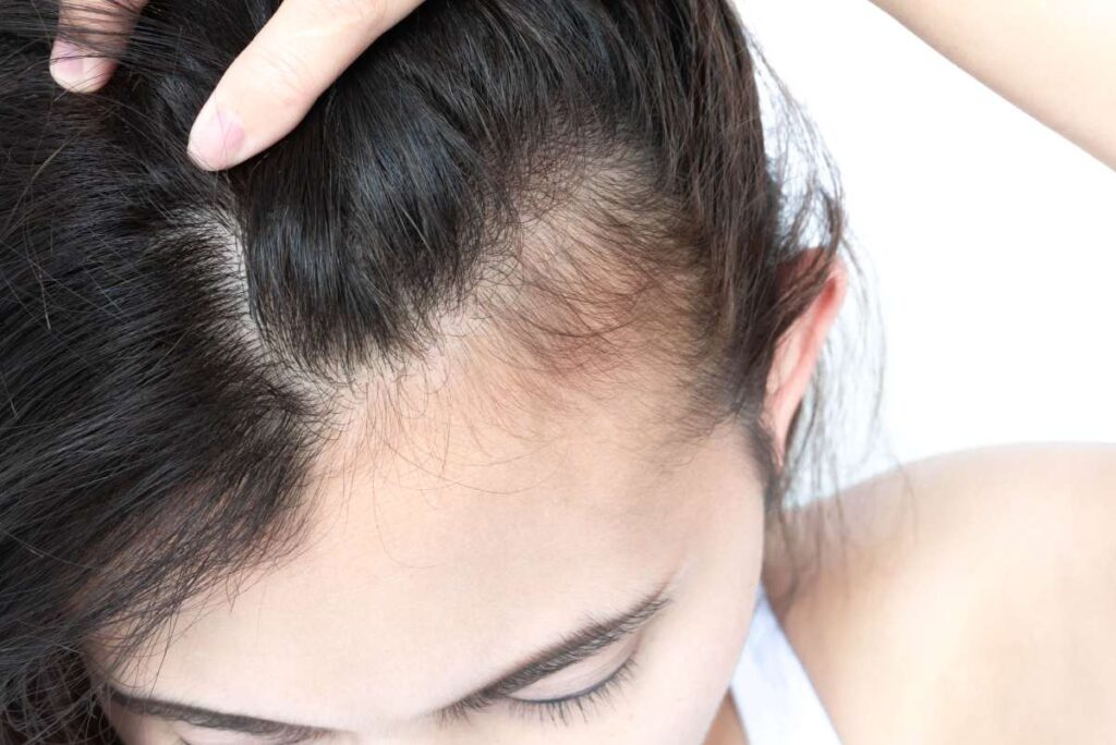 Como corrigir falhas no cabelo feminino: principais causas e os melhores tratamentos Mulher com falhas capilares visíveis na linha frontal, ilustrando rarefação causada por alopécia feminina.