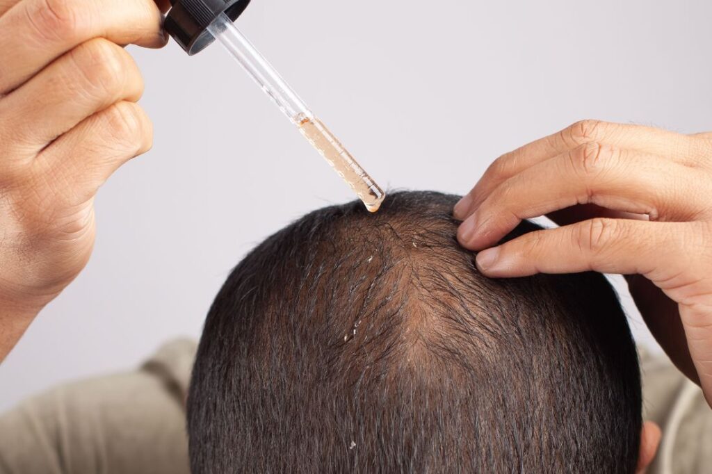 Para que serve minoxidil​? Homem aplica produto no couro cabeludo.