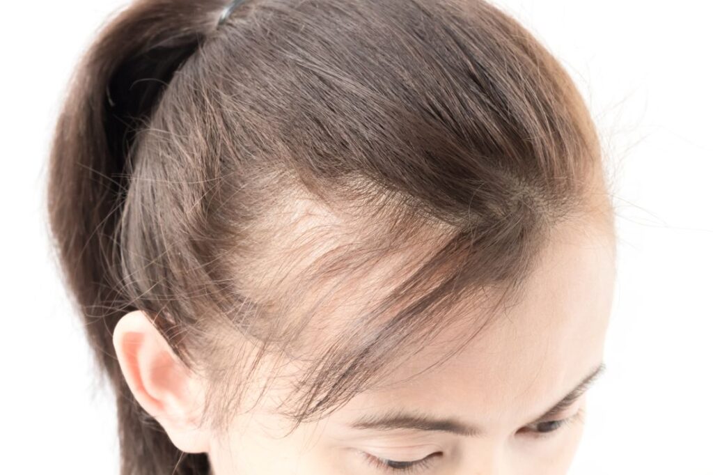 Mulher com rabo de cavalo e visíveis falhas no cabelo feminino Mulher com rabo de cavalo e visíveis falhas no cabelo feminino.